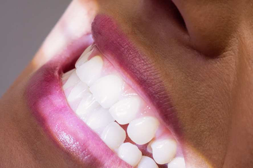 Стоматолог назвала самые вредные методы отбеливания зубов