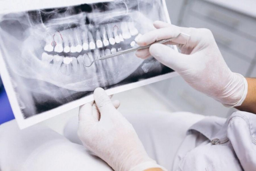 Стоматолог развеял три мифа о здоровье зубов