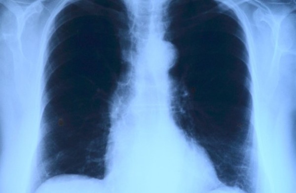 В Тамбовской области в два раза выросла заболеваемость туберкулёзом